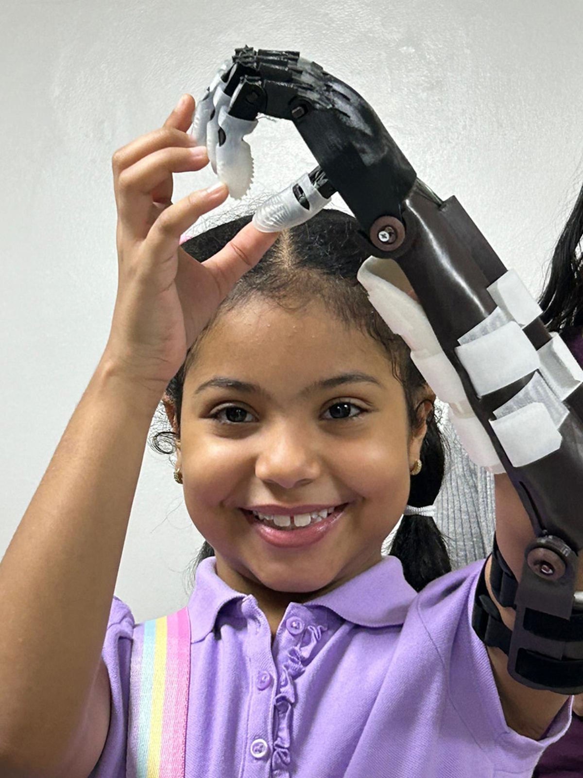 A child showing off her new hand prosthetic in Ecuador