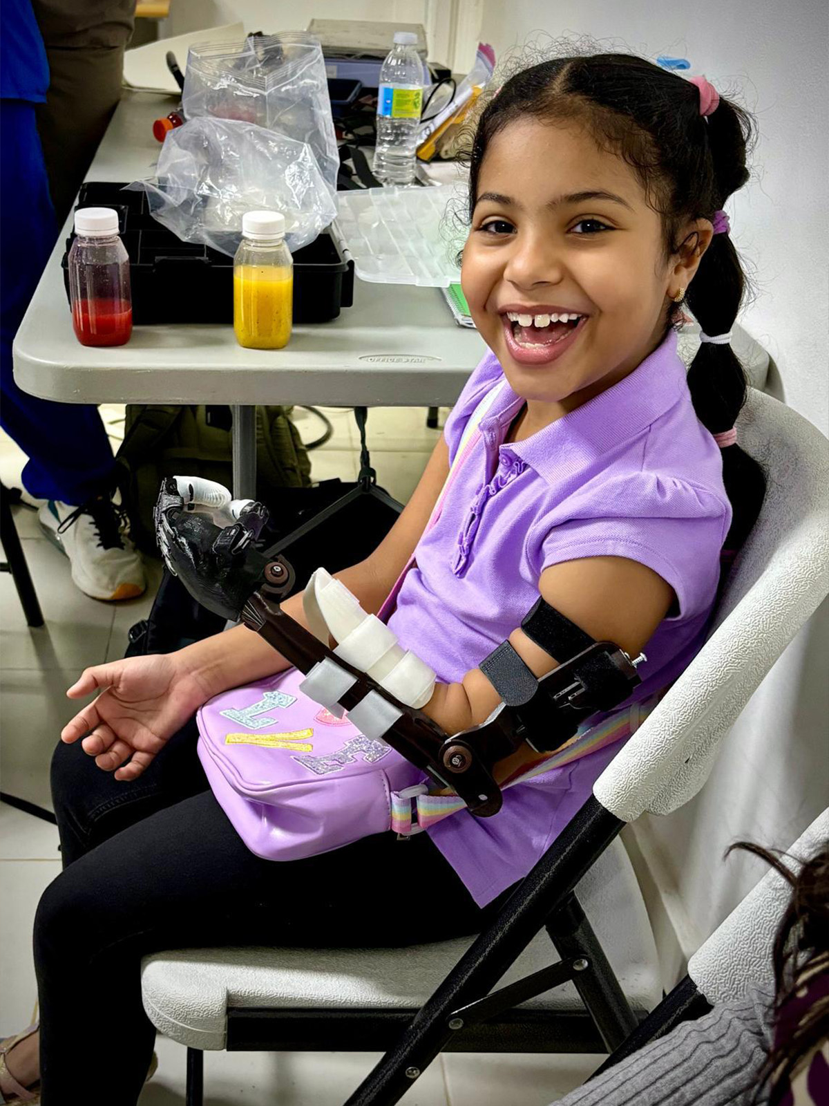 Child getting prosthetic hand fitted in Ecuador